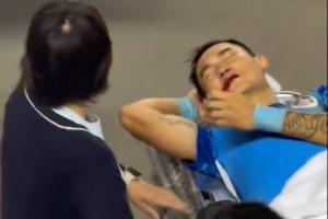 新鹏城官方：廖力生鼻骨粉碎性骨折，已完成鼻骨骨折复位术出院